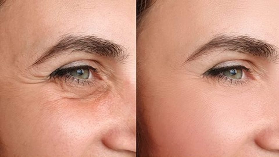 Cette crème naturelle élimine les pattes d’oie de votre visage en seulement une semaine